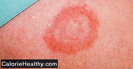 Lyme disease - illness by tick bite?