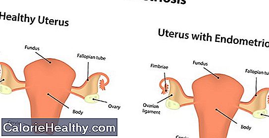 Endometriosis - cause unknown