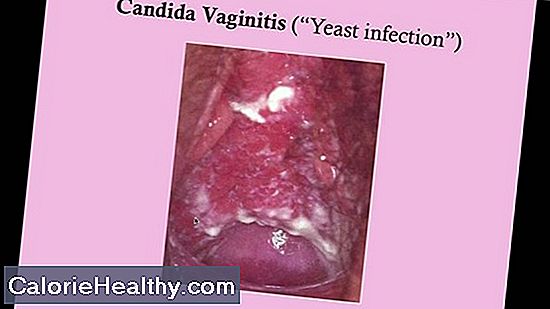 Vaginitis: cuándo buscar consejo médico