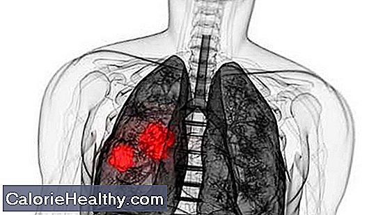 ¿Cuál es el diagnóstico de cáncer de pulmón de células pequeñas?